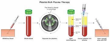 PRP injection therapy Homer Alaska