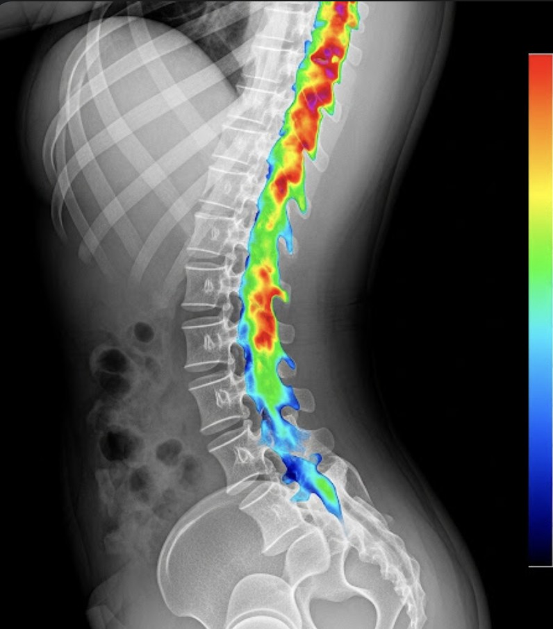 X Ray superimposed thermal image